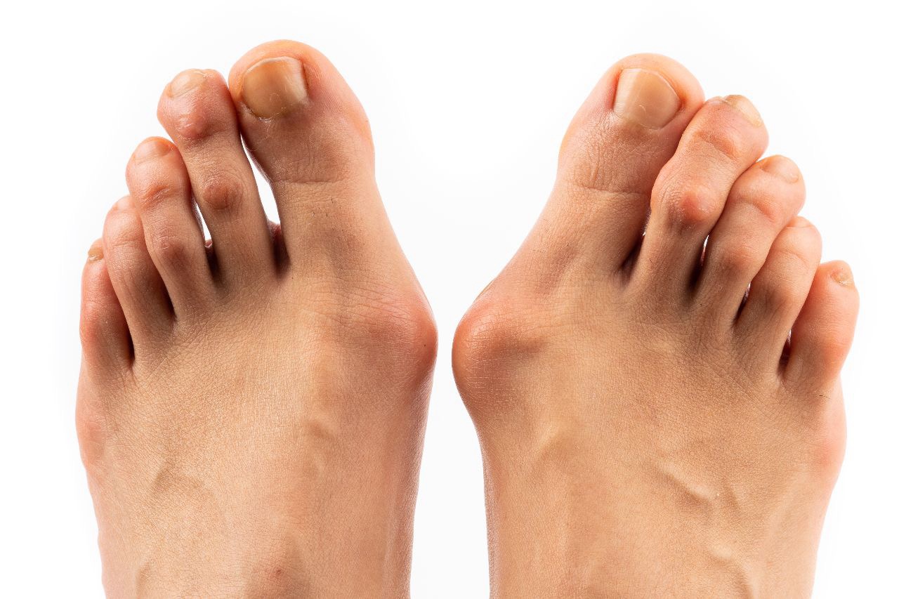 Hallux Valgus – що таке Халюс Вальгус і як лікувати «кісточку» на нозі в Одесі
