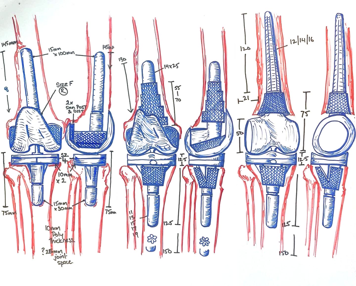 Ревізійне ендопротезування суглобів в Одесі | Повторна заміна протеза