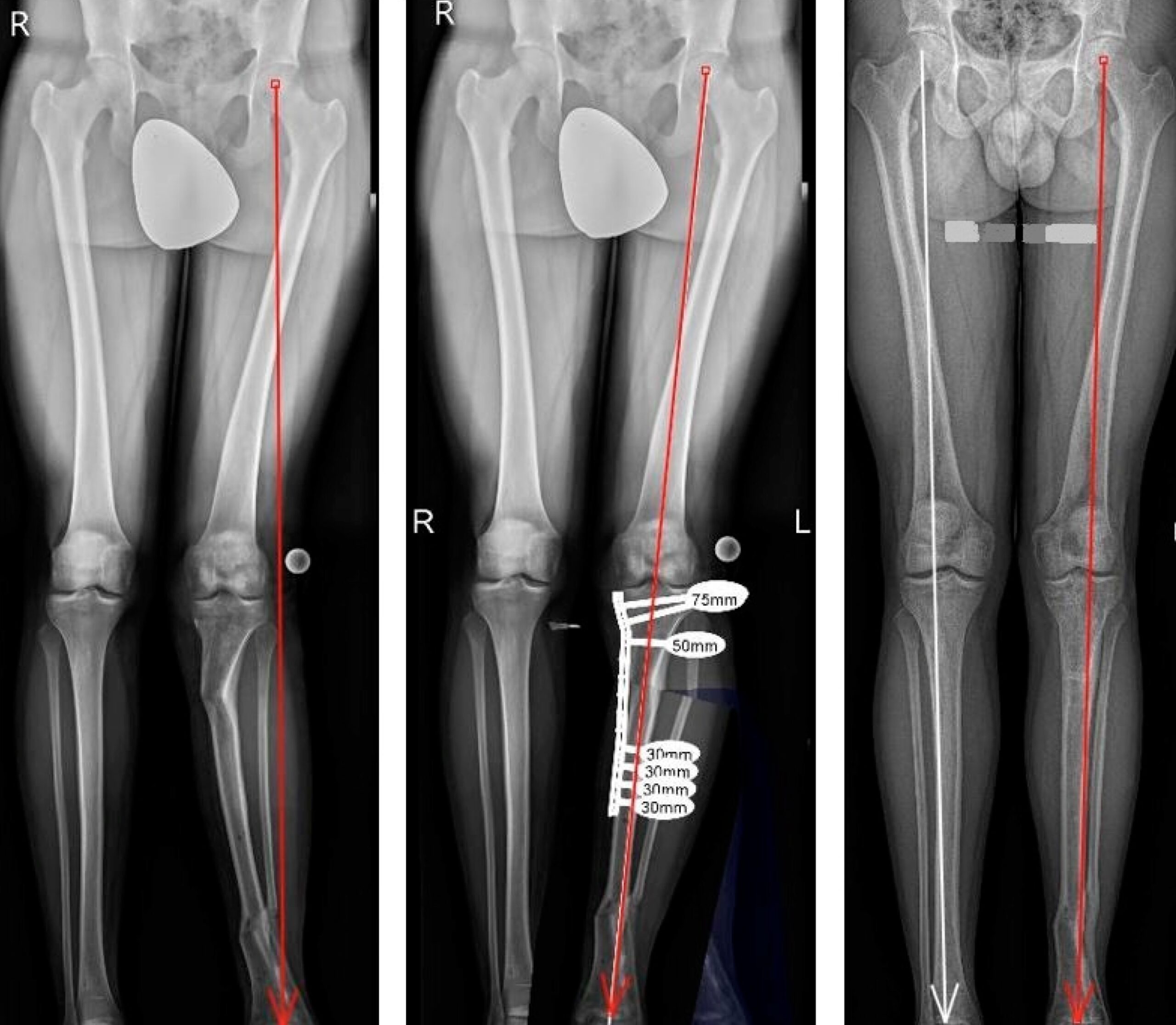 Коригуюча остеотомія в Одесі : сучасне рішення при деформаціях кісток