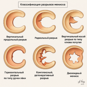 Схема разрывов мениска