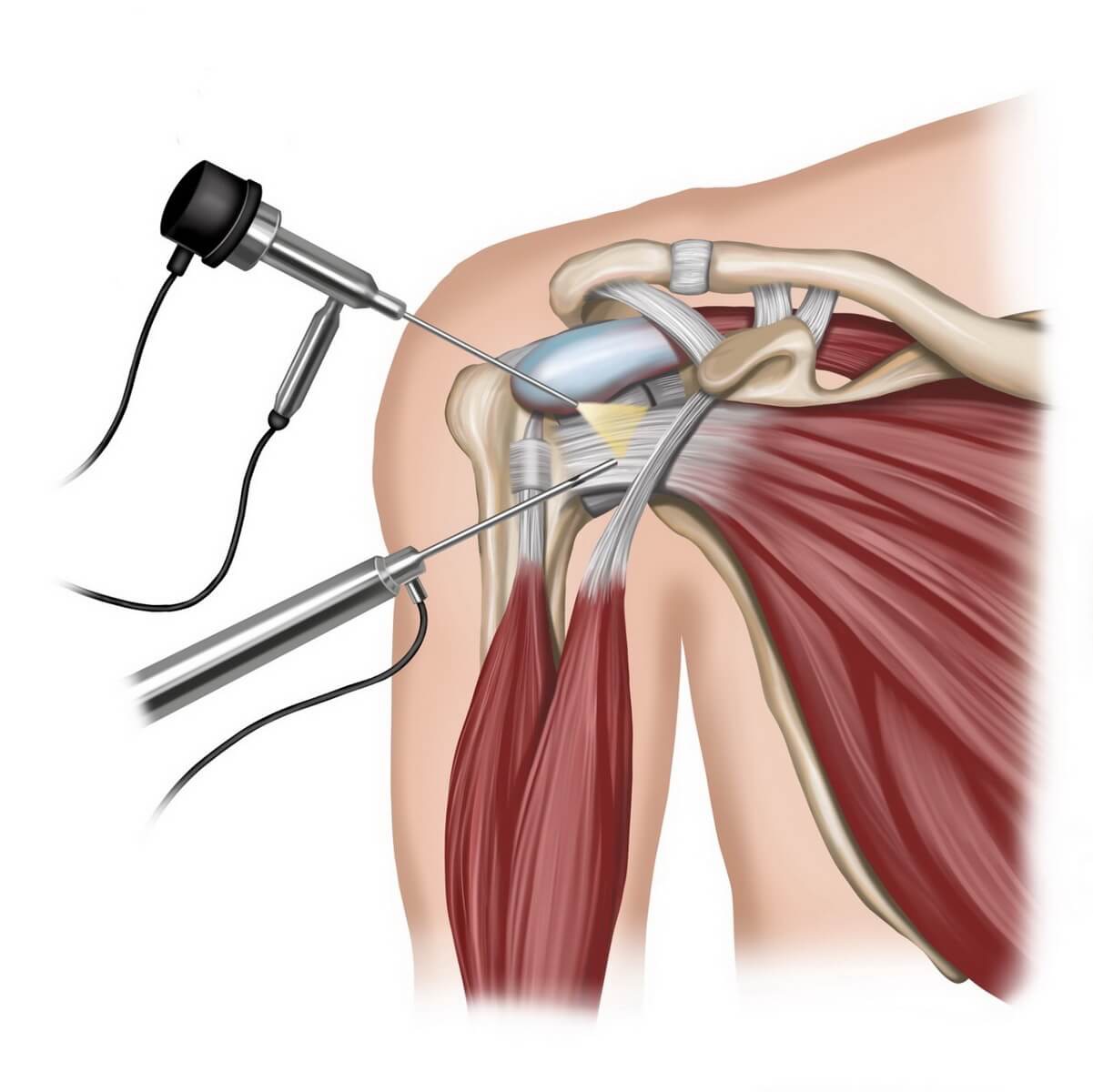 Артроскопія плечового суглоба в Одесі – малоінвазивне вирішення складних проблем